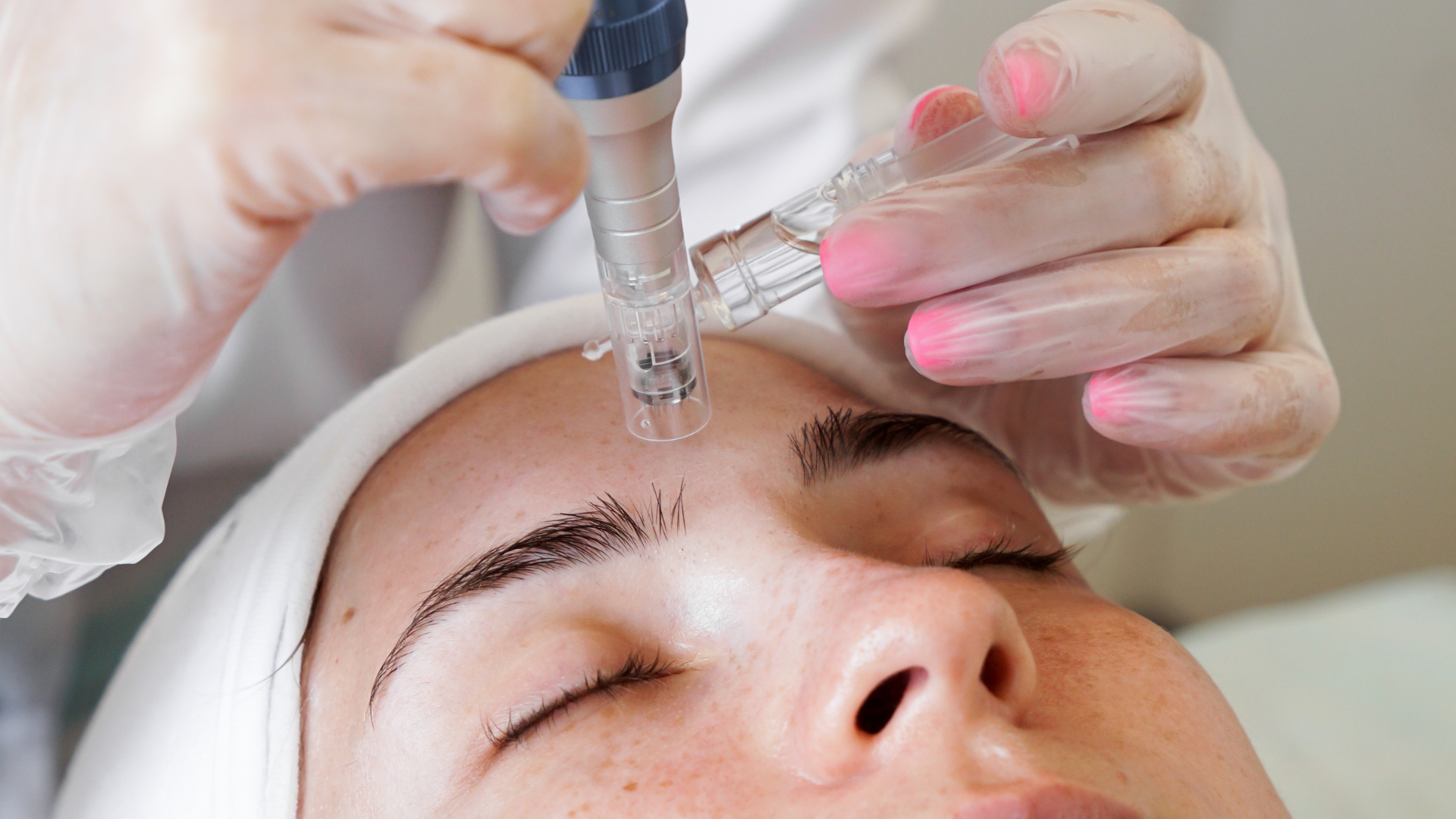 Microneedling